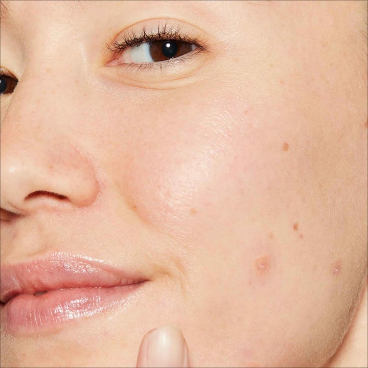 Deep Acne Liquid Patch Duo